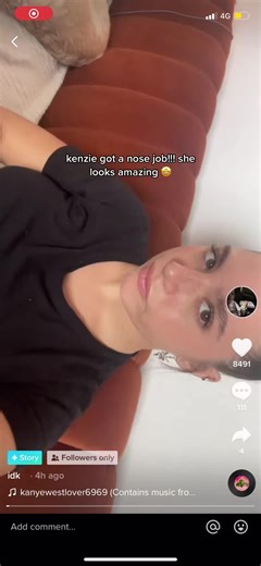 Kenzie Ziegler's Nose Job Transformation Revealed