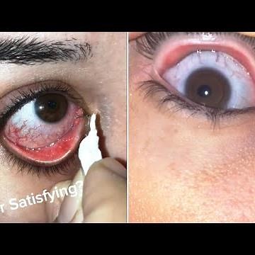 Eye booger and Eye String Removal COMPILATION - satisfying video