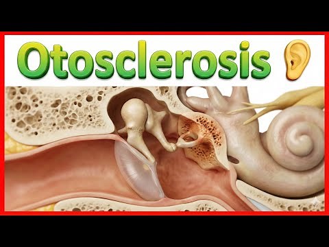 Otosclerosis 👂 : ENT Lectures