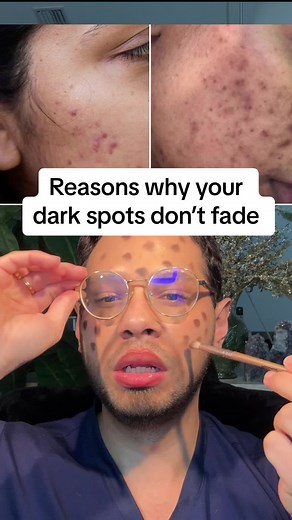 Causes of Dark Spots on Skin and How to Treat Them