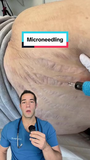 Explained: Microneedling for Stretch Marks