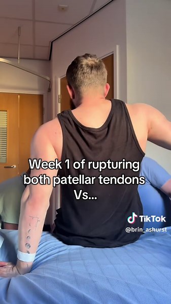 Patellar Tendon Surgery: 4 Weeks Post-Op Journey
