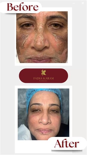 Peeling treatment ✨ Our beautiful client had severe sun damage and dark pigmentation for years. After her customized peeling session, her skin transformed into smooth, even-toned, baby-soft skin 🌸 Healthy glow. Clear complexion. Real results. #PeelingTreatment #SkinRenewal #SkinTransformation #GlowingSkin #FadiaKaramCosmetics