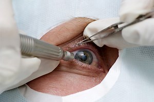 Cataract Surgery Options for Elderly Patients