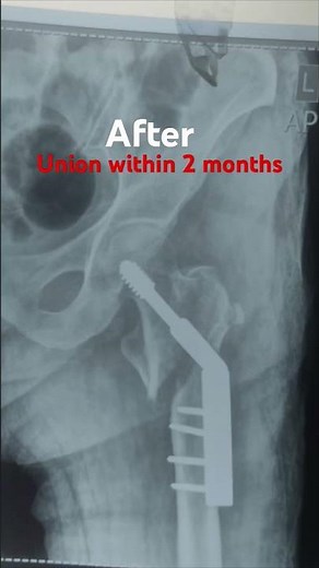 Union of intertroch fracture with Dynamic hip screw (DHS) #orthopedics #bones #union #hip #fracture