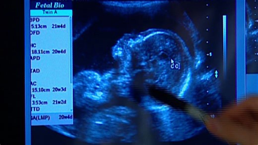 1 de cada 33 bebés en EE.UU. nace con un defecto. Conoce por qué y cómo evitarlo - CNN Video