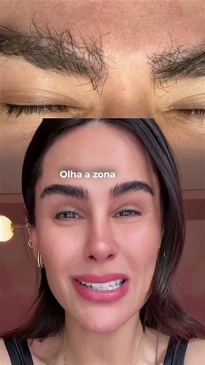 The dangers of a botched eyebrow transplant!