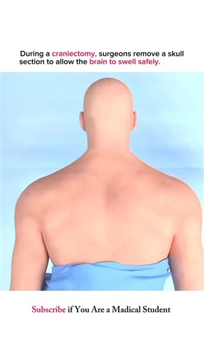 Biomedical Explained on Instagram: "Why Surgeons Sometimes Remove Part of the Skull to Save the Brain In this video, we explain how a craniectomy protects the brain by reducing dangerous pressure when swelling occurs after severe injury or medical emergencies. 📌 What you’ll learn in this video: ✔ What a craniectomy procedure actually is ✔ Why it is performed in emergency neurosurgery ✔ How it helps prevent further brain damage and supports recovery A craniectomy is a specialized neurosurgical p