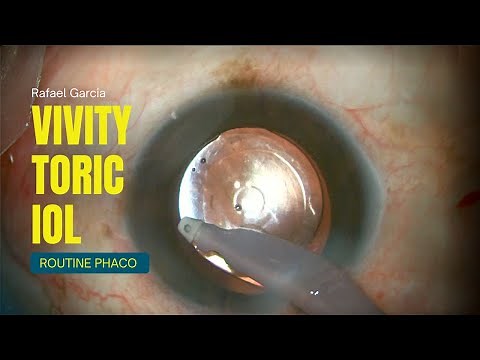 AcrySof IQ Vivity Toric IOL