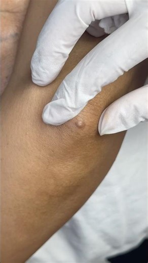 😅 Even elbows want skincare now?! #blackheads #acne #shortvideo #skincare #pimplepopping