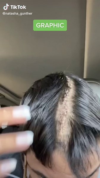Removing Brain Surgery Staples - My Experience