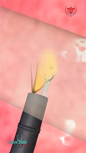 26K views · 121 reactions | Name the procedure? #procedure #lungs #surgery #fblifestyle | Dr. Muhammed Ziya | Facebook