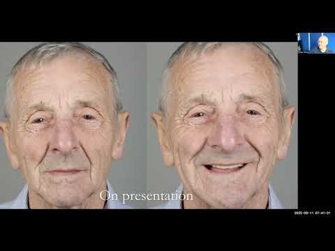 Finlay Sutton Complete Denture Case – Patient Who Never Wore a Lower Denture Before Study Club
