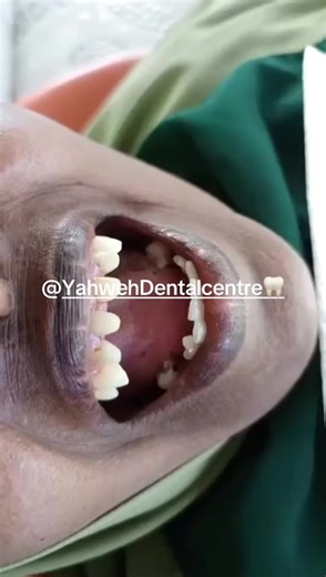 #dental #butiye #fyp #ethiopian_tik_tok🇪🇹🇪🇹🇪🇹🇪🇹 #manyatta @essy love @FelixSmoak @@Roman544 @Amor sash @alexo @Mark Adde