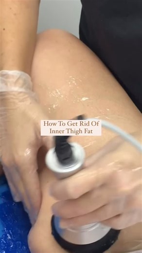 Permanently remove unwanted fat in your inner and outer thighs with Sonder’s effective fat cavitation treatment. Ultrasonic cavitation is an effective, noninvasive procedure to target stubborn fat deposits in the thighs that aren’t moving with diet or exercise. The treatment can help you lose inches, with visible results after one session. Want to start your body journey? Contact us for your free consultation with our Body Specialists. - ー #sonderprivateclinic #fatreductionbrisbane #fatdissolvin