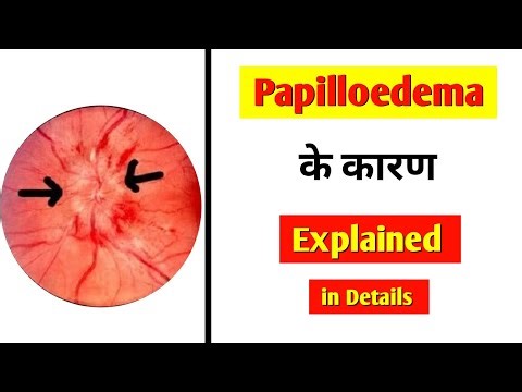 Papilloedema Ke karan explained| Causes of Papilloedema| Optic disc edema Clinical features| Symptom