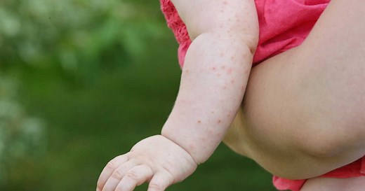 Roséole : contagion, symptômes, reconnaître les boutons, traitements