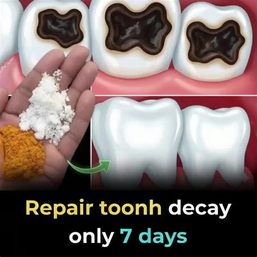 100% Natural Home Remedy for Tooth Decay, Yellow Teeth, and Tooth Pain 👇 | Simple Home Tips