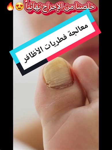خلصنا من الإحراج نهائياً 😍🔥#علاج_فطريات #العناية_بالقدم #نتائج_مضمونة