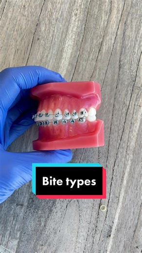 Understanding Different Types of Bites