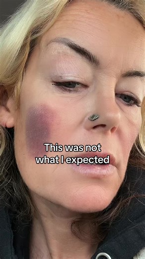 Any products i review I make sure I always give honest and accurate feedback. This was not meant to happen trying out a lymphatic drainage device for the first time!! I’m really not impressed at all and this is going to take several days to heal 🔥 Additionally how am I meant to review skincare whilst my face is completely bruised. What’s your opinion on this? #lymphaticdrainagemassage #review #skintok #honest