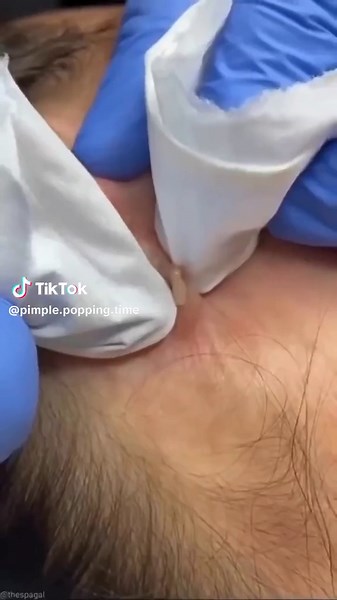 Epic pimple popping compilation #pimple #pimplepopper #extractions #compilation