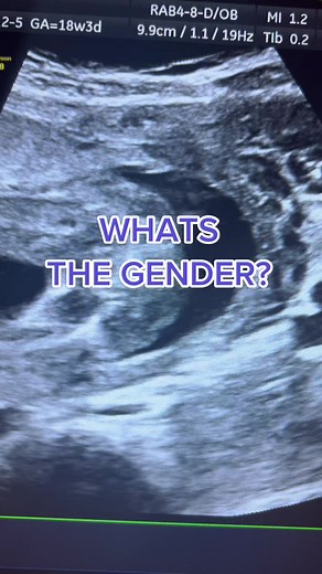 18-Week Baby Gender Prediction with 5D Ultrasound