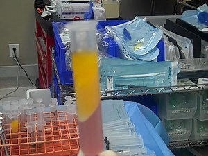 Fat Transfer: See What Fat Looks Like After It's Been Centrifuged