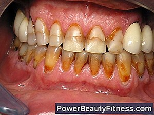 Implants Vampire Dents 💪💪 Tout À Propos Des Modes De Vie Sains Et De Remise En Forme - 2025