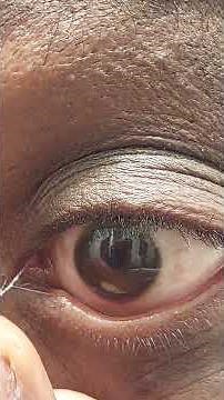 Stringy!! Mucus Eye Fishing Syndrome Eye Gunk Removal