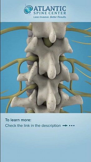 What Is Lumbar Lateral Stenosis? | Foraminal Stenosis #Shorts