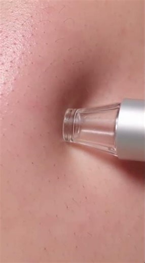 Upper Cheekbone Sebum Removal | Ultra-Realistic ASMR #asmr #skincare