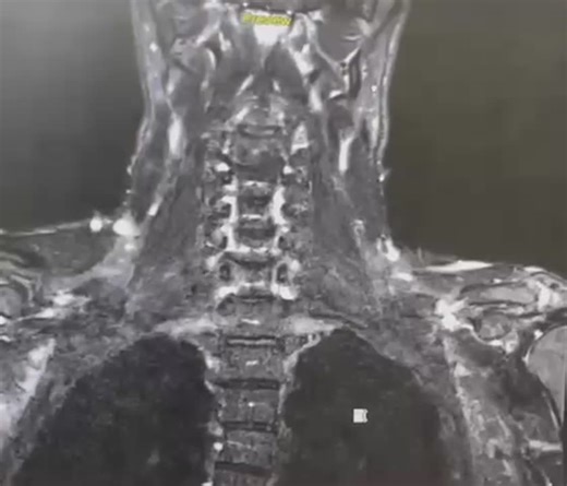 #mri #radiography #brachialplexus #siemenshealthineers #radiology #clinicalimaging #deepresolveboost #neuroradiology #postsurgicalimaging #mripractice #metalartifactreduction #radiologist #radiology | Kareem Qatouni