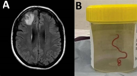 Wriggling, live worm removed from Australian patient’s brain in world-first