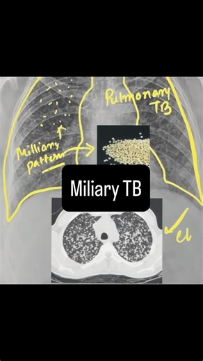 Dr Zulfikar Ali Arain on Instagram: "Miliary tuberculosis (TB) is a rare and potentially fatal form of tuberculosis that occurs when large amounts of the Mycobacterium tuberculosis bacteria spread through the bloodstream and throughout the body. It’s characterized by the formation of tiny tubercles in various organs, resembling millet seeds in size. Symptoms and diagnosis: Miliary TB can present with nonspecific symptoms like fever, night sweats, and joint pain, making diagnosis challenging. #tu