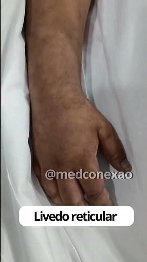 O livedo reticular é uma...