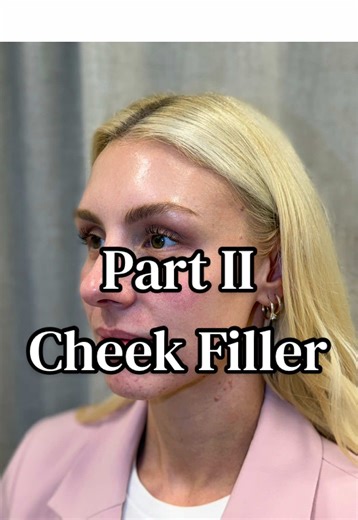 Part 2 of my cheek filler journey 🤍 First, we created lateral support. Now we’re slowly adding medial volume for balance. I’m big on going slow with filler and letting it settle before adding more. That’s how we keep results natural and structured, not overdone. Subtle changes. Big difference. @Gold Bar Aesthetics #columbusohio #filler #nurseinjector