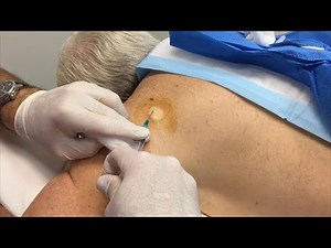 Epidermoid Cyst Removal for Flash! New Girl Needs a Nickname