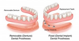 Preprosthetic Surgery in Ventura, CA - Dentures and Implants