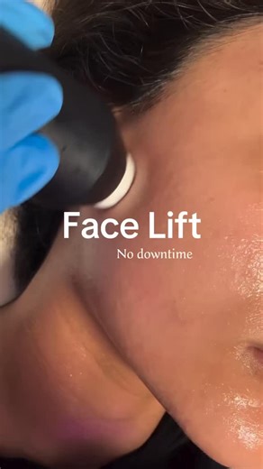 OxyGeneo™ | CANADA’S #1 SUPER FACIAL on Instagram: "The Geneo X integrates TriPollar® radiofrequency technology to deliver safe, non-invasive skin tightening with immediate and long-term results. Here’s how it works: 1 Controlled RF energy penetrates the dermal layer while maintaining patient comfort. 2 This targeted energy stimulates fibroblasts to increase natural collagen and elastin production. 3 The result is dermal volumizing and skin tightening, creating a smoother, firmer appearance. 4 O