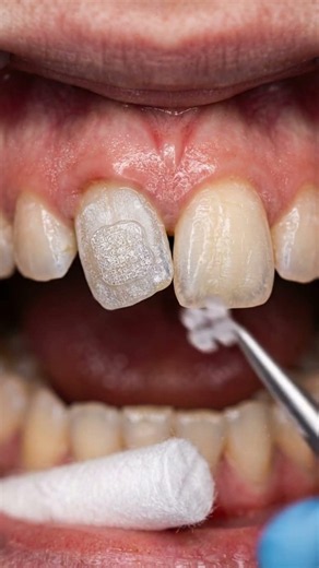 Transforming a Twisted Front Tooth to Make it Perfectly Straight Instantly
