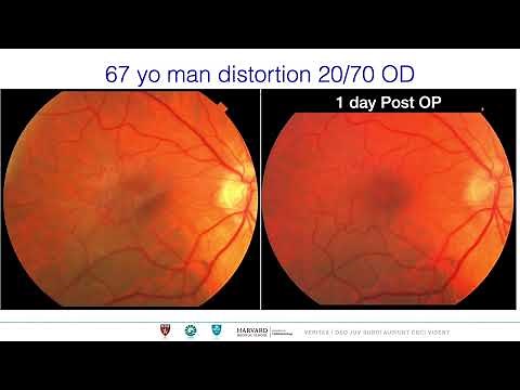 Epiretinal Membrane (ERM) Macular Pucker , epiretinal proliferation. Need for ILM peel ? Basics (HD)