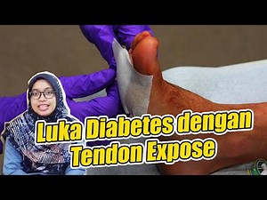 Perawatan luka dengan tendon expose