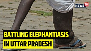 Elephantiasis is a disease transmitted through bite of infected mosquitoes which causes swelling in legs, arms, other parts of the body. For years, villages in Uttar Pradesh turned to quacks & faith healers for 'treatment'. Now there are winds of change Himani Chandna brings a detailed ground report #Elephantiasis #UttarPradesh #Disease #Health | News18