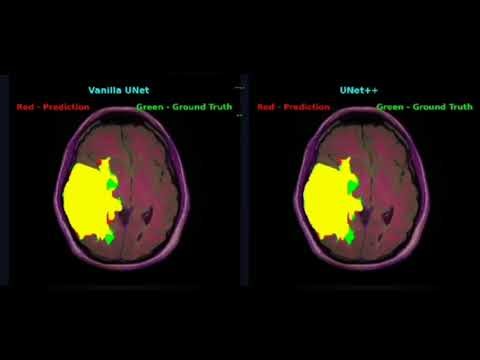 Comparative Evaluation of UNet and UNet++ for Brain Tumor Segmentation