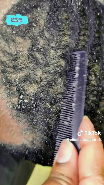 Extreme Dandruff Removal: Satisfying ASMR Experience
