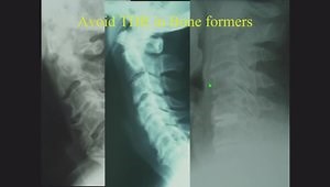 How Do I Decide Between Cervical TDR and ACDF?