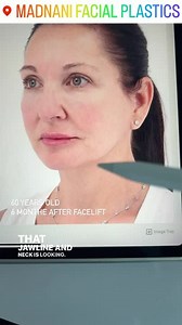 Facelift and Neck Lift Before and After