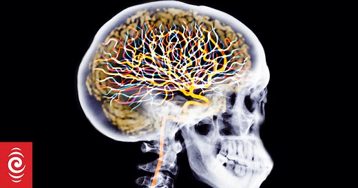Run It and brain injuries: What you need to know
