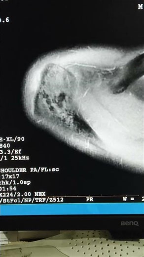 MRI scan shoulder #healthcare #baby #science #hospital
